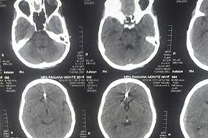 Post op ct of Acom Coiling
