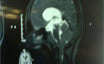 preop mri 1