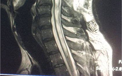 Arnold Chiari Malformation