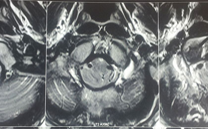 ar ch pre op axial