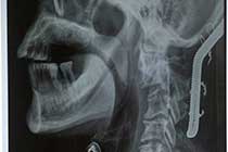 Post OP X-Ray of Hartshill Loop