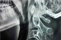 Atlanto Axial Dislocation Extension X-Ray