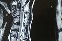 Pre OP Fixed AAD With Foramen Magnum Compression