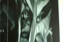 Pre OP Foramen Magnum Compression With AAD