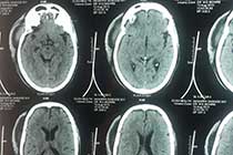 CT Scalp Abscess