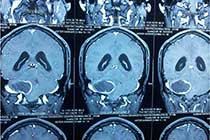 Cerebellar Abscess