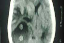 Temporal Abscess