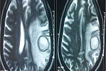 T2W of TB Granuloma