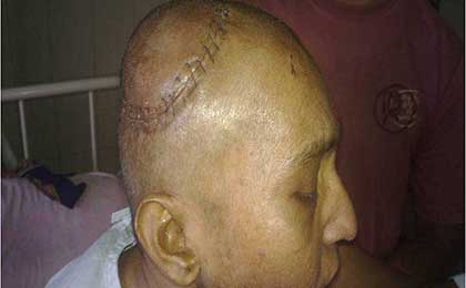 Post OP Clinical of CA Breast With Solitary Brain MET