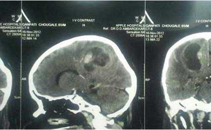 RT Parasaggital Lesion Sec From CA Lung,CT PRE OP