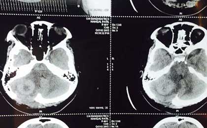 Solitary Cerebellar Met in CA Breast PRE OP