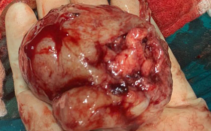 Brain Tumor Surgery  14/02/2019