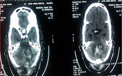 post op ct