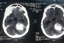 big cp angle meningioma pre op