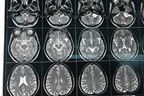 cp angle meningioma