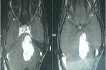 left cp angle residual tumor pre