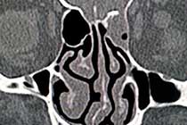 CT For CSF Leak