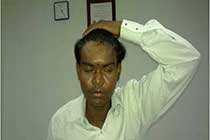 transcranial csf leak repair