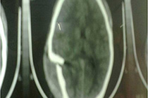 pre op ct