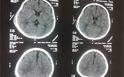 CT of Dai