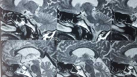 Endoscopic Surgery