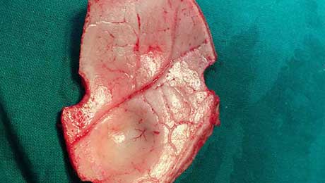 Epilepsy Surgery