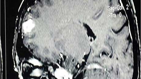 Epilepsy Surgery