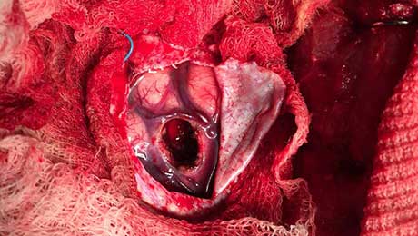 Epilepsy Surgery