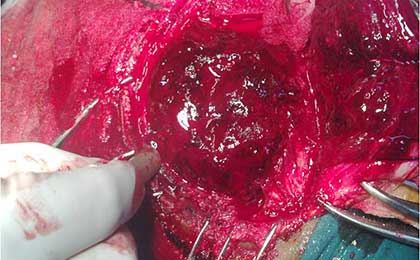 Extradural Haematoma