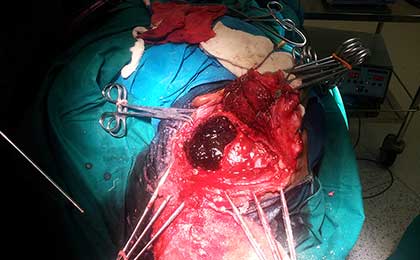 Extradural Haematoma