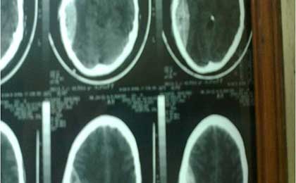 Extradural Haematoma