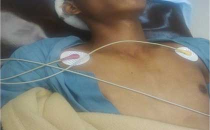Extradural Haematoma