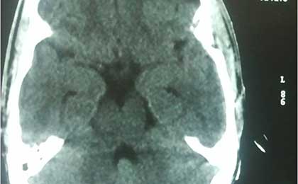Extradural Haematoma