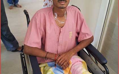 Fat Embolism Syndrome
