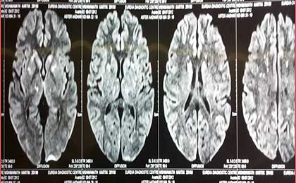 Fat Embolism Syndrome