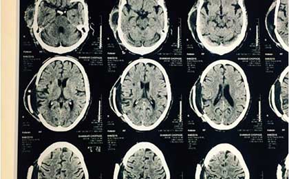 Gliomas of Brain