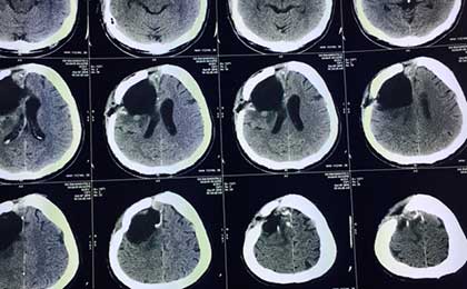 Gliomas of Brain