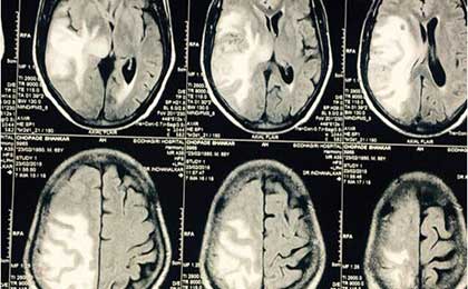 Gliomas of Brain