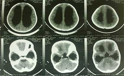 Hydrocephalus