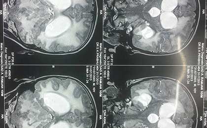 Hydrocephalus