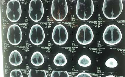 Hydrocephalus