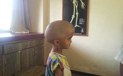 Hydrocephalus