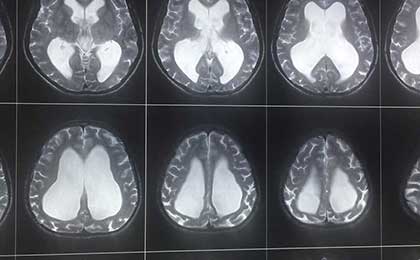 Hydrocephalus
