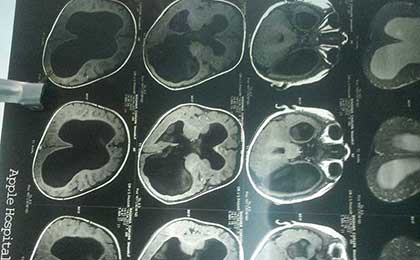 Hydrocephalus