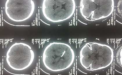 Hydrocephalus