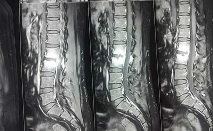 Infection in Spine