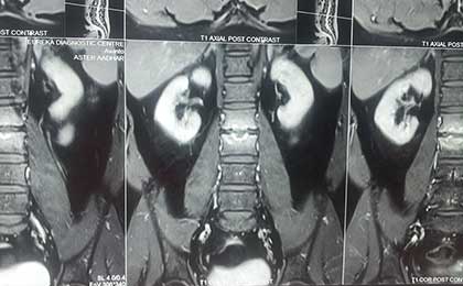 Infection in Spine