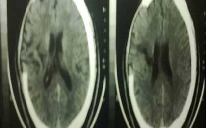 Intracerebral Haematoma