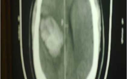 Intracerebral Haematoma