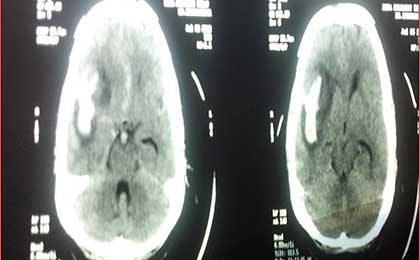 Intracerebral Haematoma